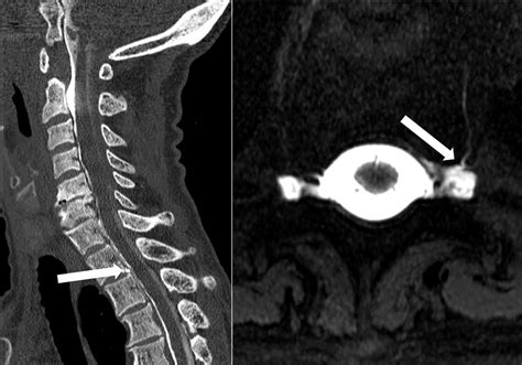 csf drop test|ct scan for csf leaks.